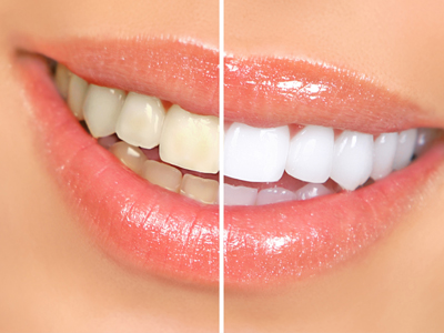 TEETH WHITENING