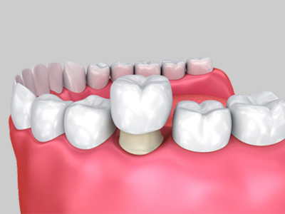 DENTAL CROWNS