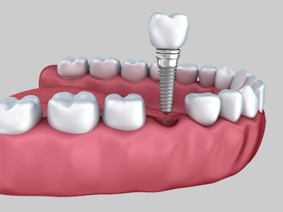 DENTAL IMPLANTS