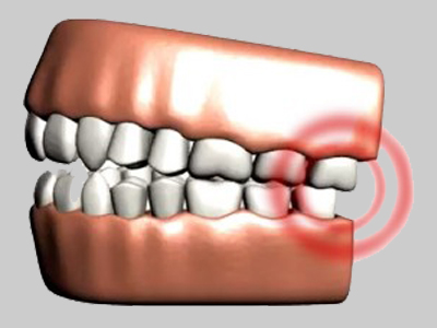 JAW JOINT DISORDERS - DENTAL CARE