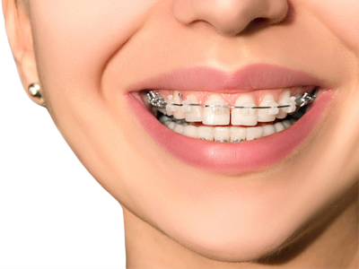 ORTHODONTICS / BRACES TREATMENT